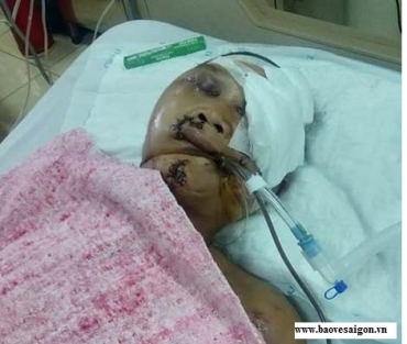 ho tro 140 trieu cho bao ve ngheo bi tai nan